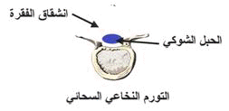 myelomen%20%281%29.gif