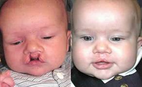 cleft-s%20(3).jpg