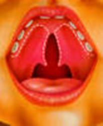 cleft-s%20(5).jpg