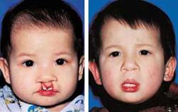 cleft-s%20(6).jpg