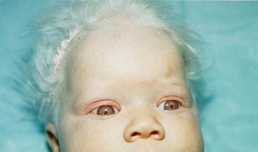 Albinism%20%284%29.j
