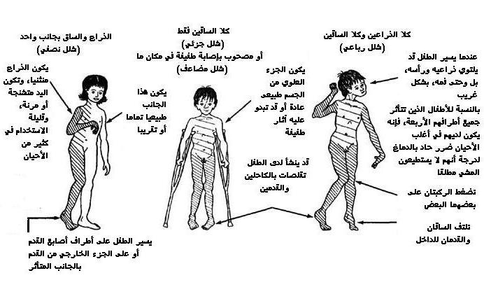 الشلل الدماغي؟ CP-B%20(10).jpg