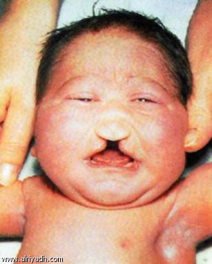 Cleft_LP%20%282%29.jpg