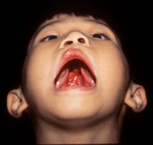 Cleft_LP%20%284%29.jpg