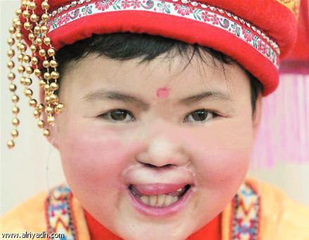 Cleft_LP%20%286%29.jpg