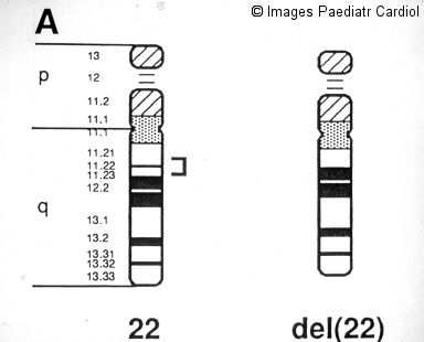DiGeorge_Syndrome%20(1).jpg