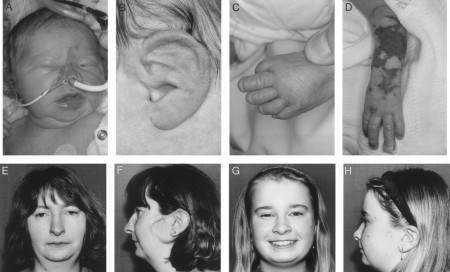 DiGeorge_Syndrome%20(3).jpg