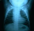 DiGeorge_Syndrome%20(6).jpg