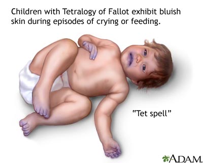 DiGeorge_Syndrome%20(7).jpg