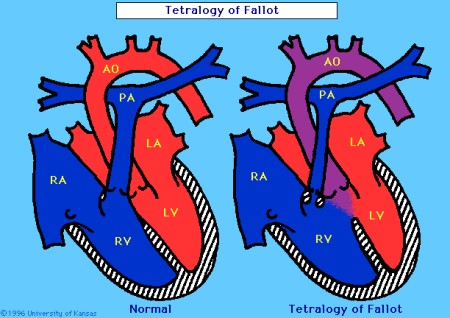 DiGeorge_Syndrome%20(8).jpg
