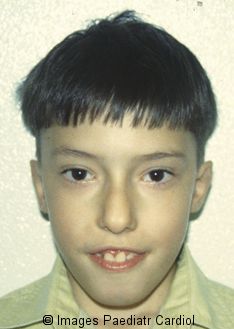 DiGeorge_Syndrome%20(9).jpg