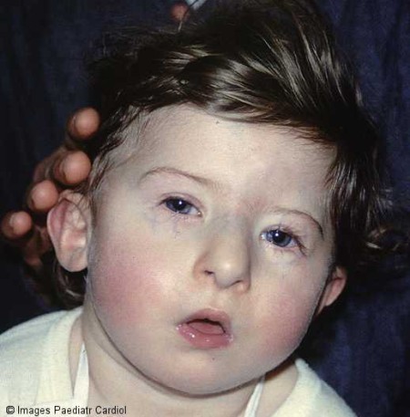 DiGeorge_Syndrome.jpg