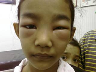 أطفال الخليج المتلازمات المتلازمة المرضية الكلوية التناذر النفروزي nephrotic syndrome