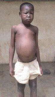 أطفال الخليج المتلازمات المتلازمة المرضية الكلوية التناذر النفروزي nephrotic syndrome