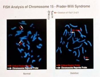 Prader-Willi%20%2811%29.jpg