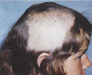 Trichotillomania%20%281%29.jpg